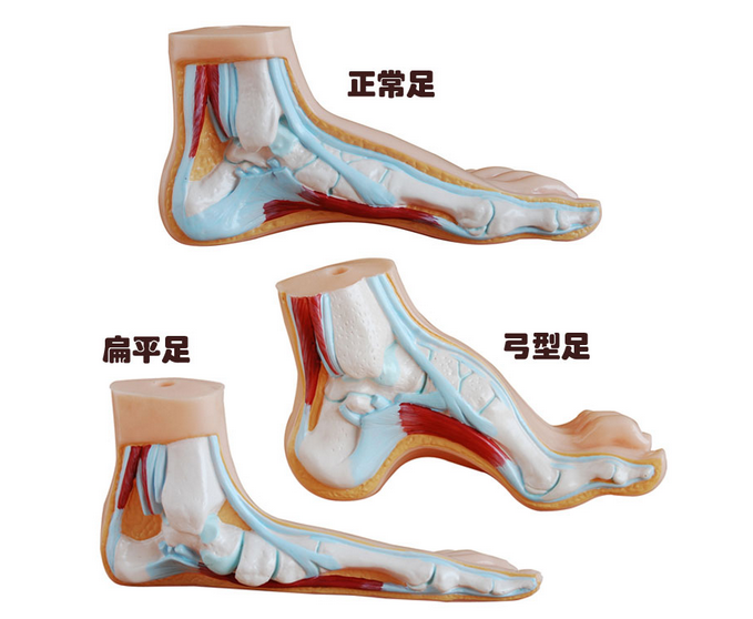 正常足、扁平足、弓型足模型